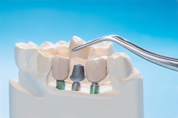 Maintenance Tips To Help Dental Crowns Last